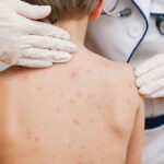 Brote de sarampión: distribuyen vacunas para frenar los contagios