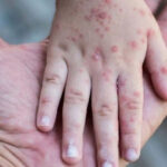 Tras 20 semanas sin nuevos casos, la Provincia declaró extinto el brote de sarampión